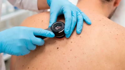 Avance en el tratamiento del cáncer de piel: vacuna de ARNm logró prevenir su reaparición
