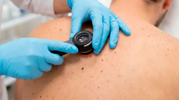 Avance en el tratamiento del cáncer de piel: vacuna de ARNm logró prevenir su reaparición