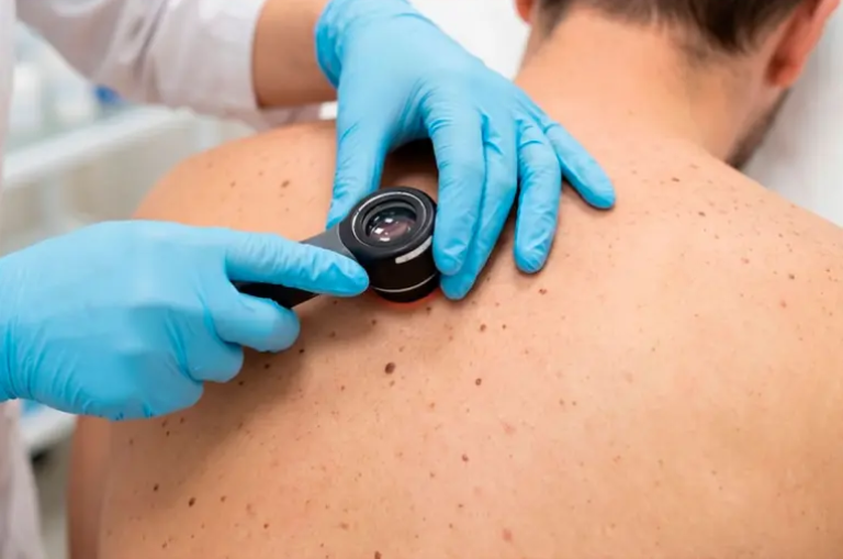 Avance en el tratamiento del cáncer de piel: vacuna de ARNm logró prevenir su reaparición